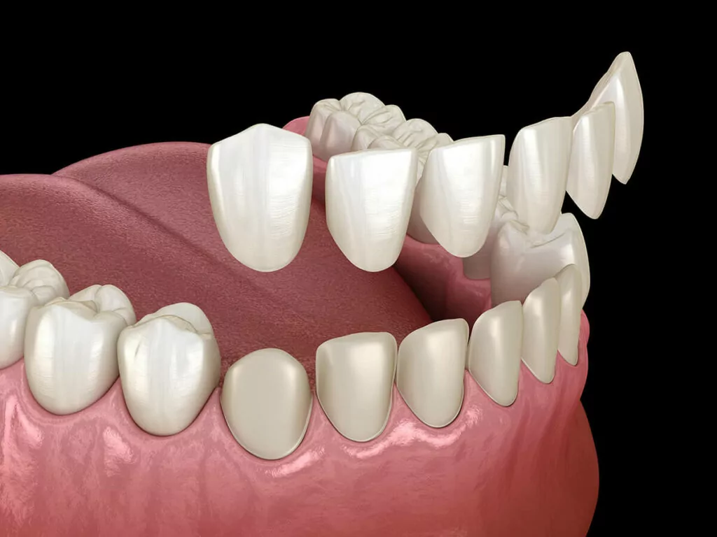 illustration of dental veneers being placed on old teeth