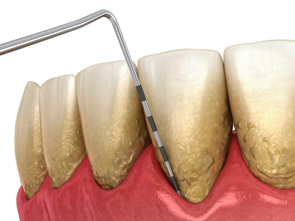 illustration of gum disease effecting teeth