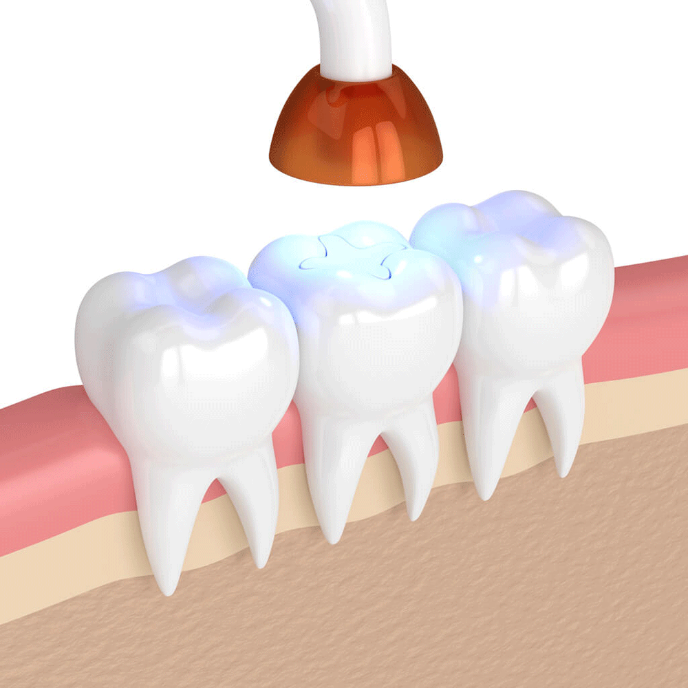 illustration of tooth filling being sealed