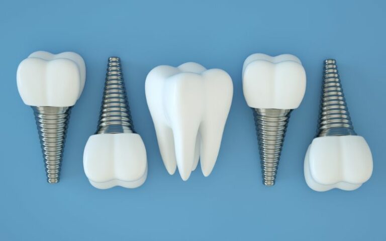 illustration of dental implants laid out on a blue background