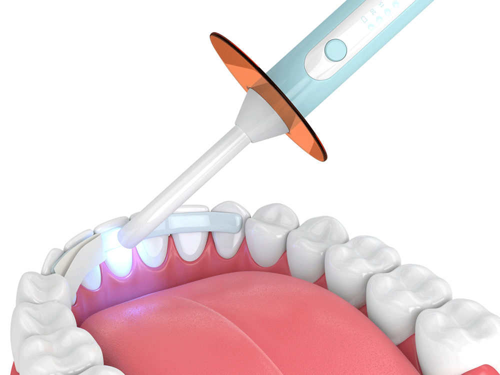 illustration of dental bonding
