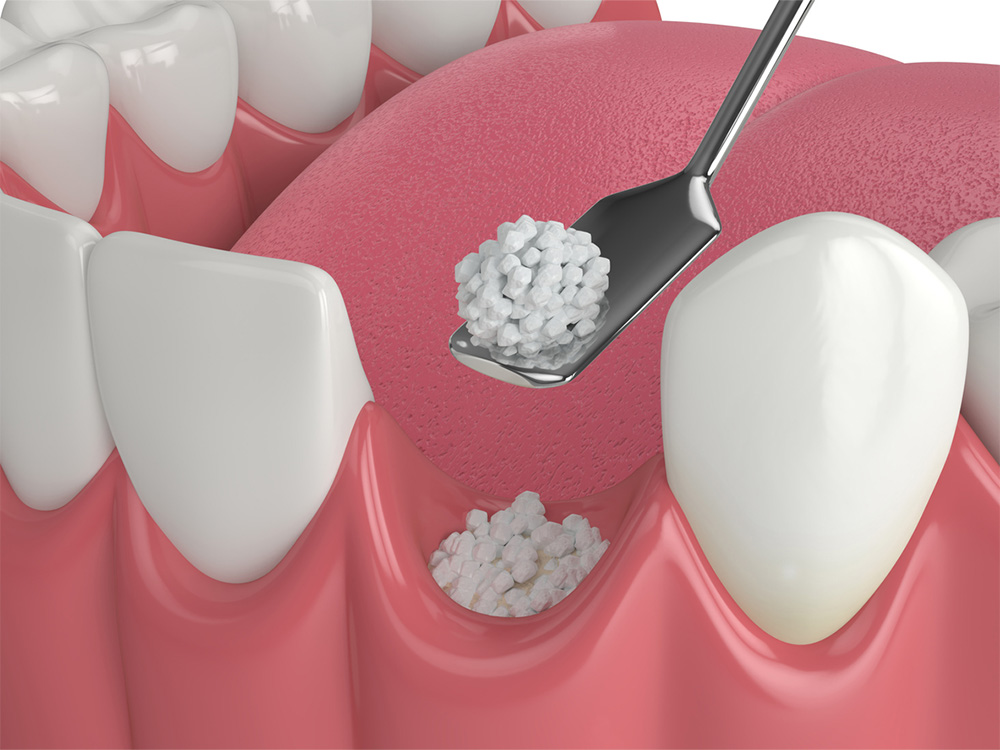 illustration of grafted bone being put in an empty tooth socket
