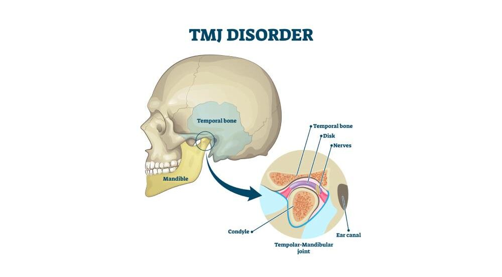 diagram of a tmj affected jaw